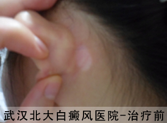 侧耳部位白癜风治疗前相片