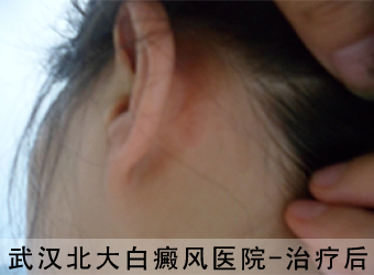 侧耳部位白癜风治疗后相片