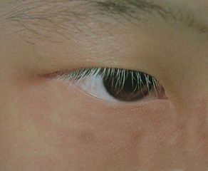 湖北武汉16岁少女眼部白癜风治疗案例