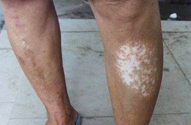 湖北治疗白癜风医院提醒白癜风患者皮肤干燥会影响疗效