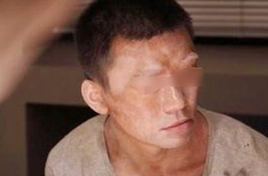 男性脸部患白癜风的危害是什么呢?