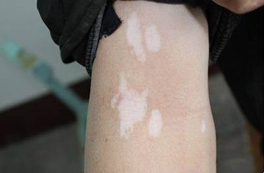 湖北患者日晒后皮肤上出现清晰状的白点是什么?